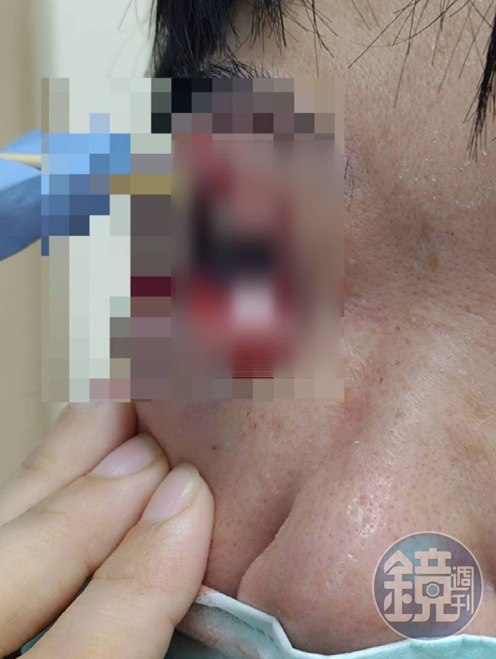 一句「請回去坐好」 特教生持斷掃把戳女代課老師眼睛大失血近失明