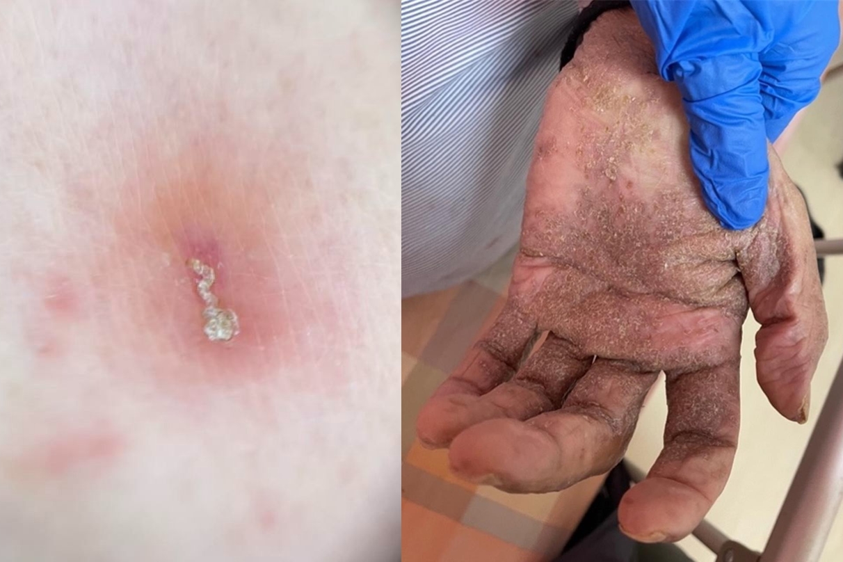 典型疥瘡患者身上約有10至15隻疥蟲，部分病灶可見「蟲隧道」（左）跡象。（北榮提供）