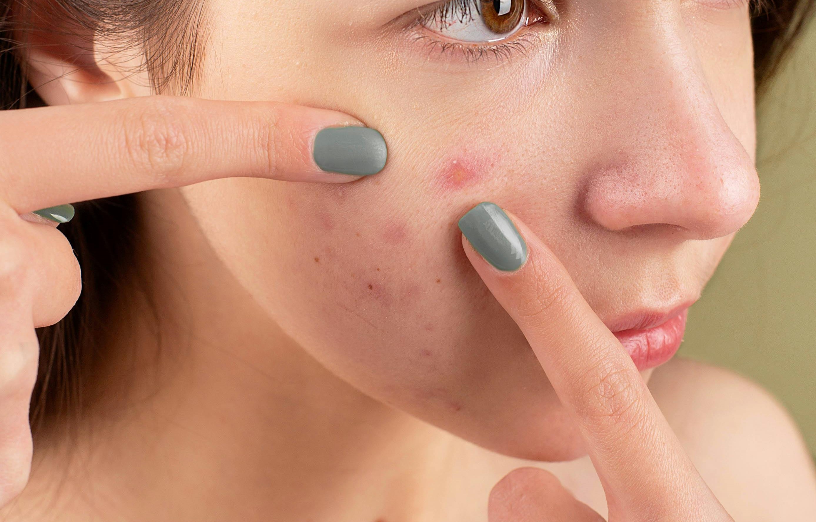 許多人發現有痘痘就會手癢想把它擠掉，然而，有些痘痘的位置去擠它是非常危險的。（示意圖，非當事人／pexels）