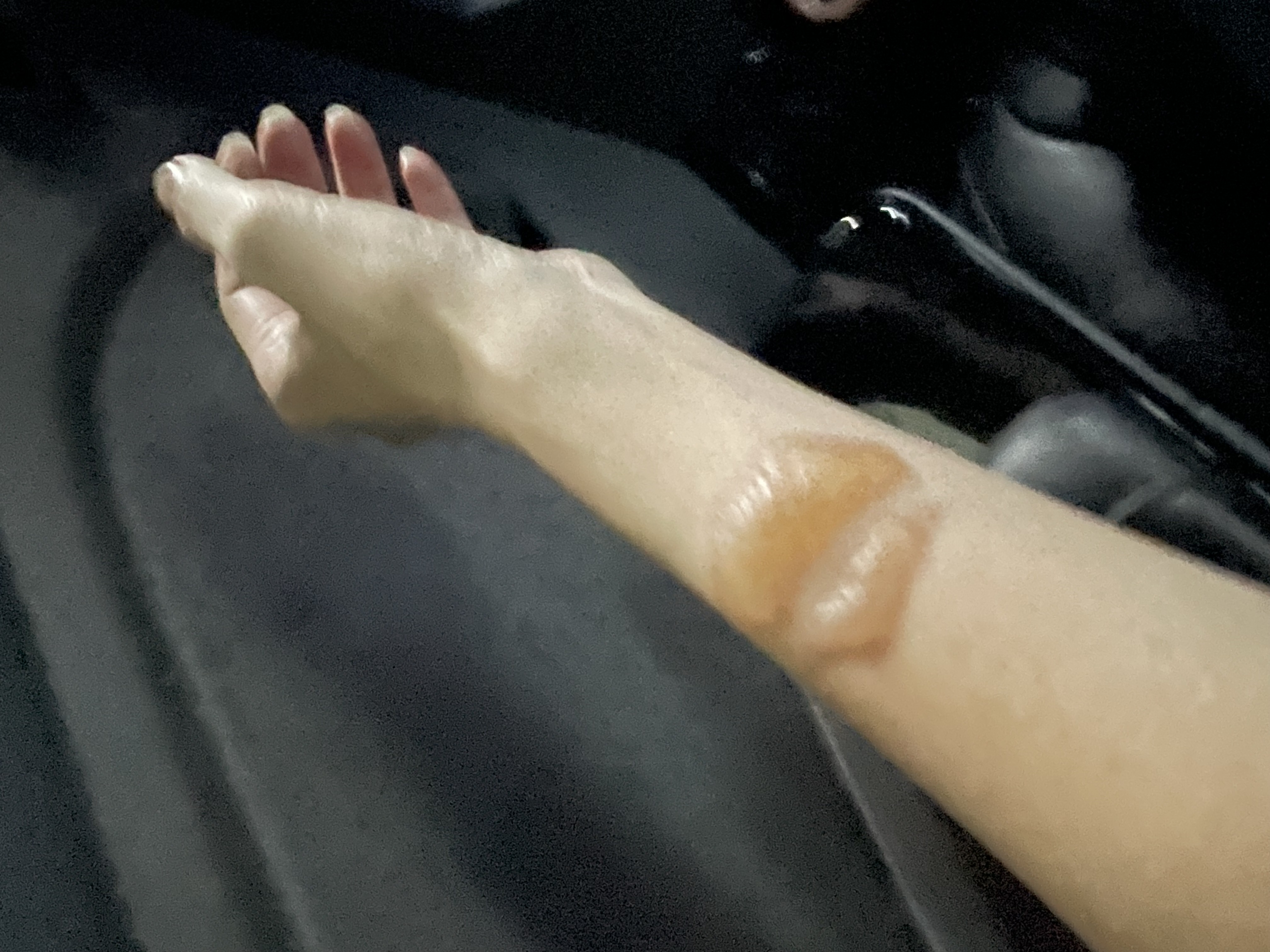 邱妻手臂遭安全氣囊爆開的高熱灼傷。(讀者提供)