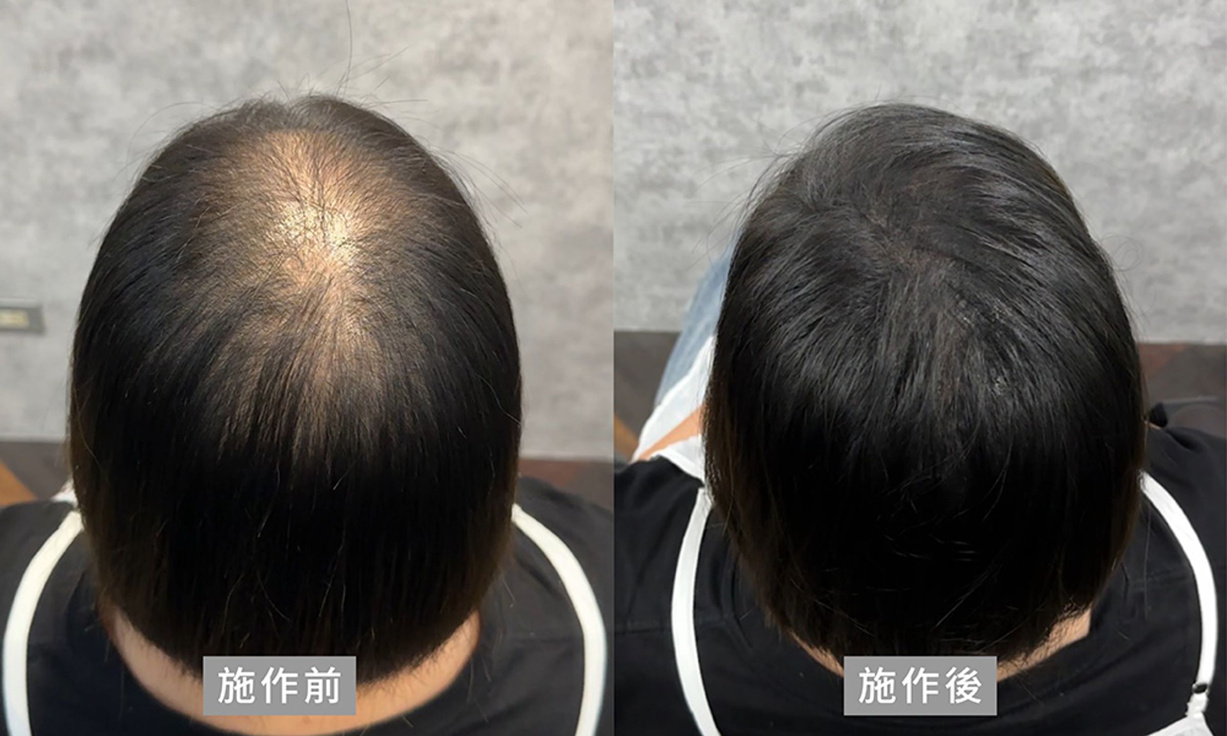 女性無修圖施作前後的差異對比,明顯感受視覺上髮量的變化(Aaron提供)。