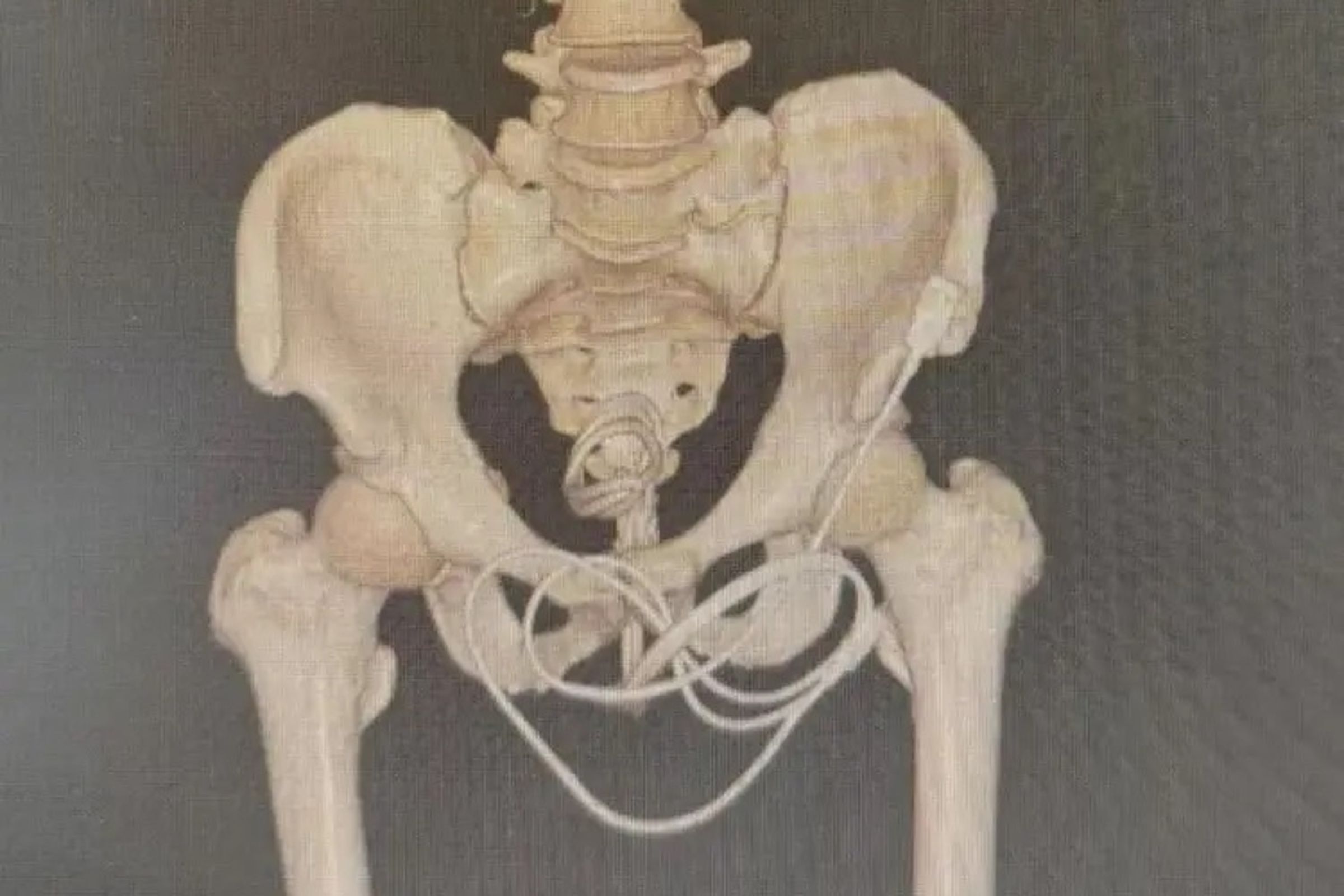 醫師替他進行骨盆腔3D電腦斷層檢查後,發現1條長約80公分的充電線。(翻攝自南方都市報)
