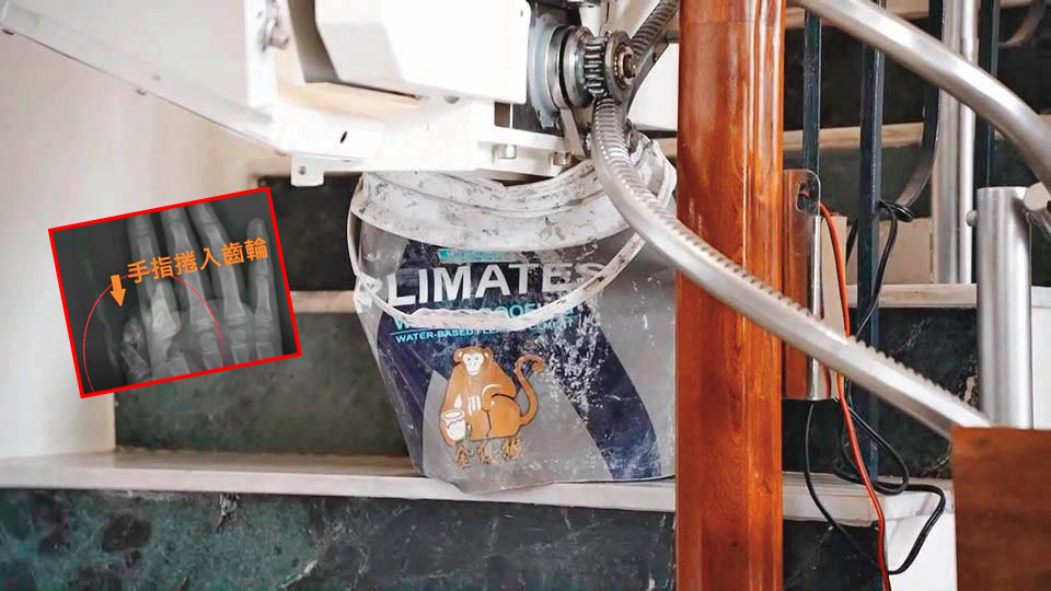 吳小姐購買樓梯升降椅，為了讓長輩方便上下樓梯，卻因產品瑕疵，造成幼童的大拇指遭壓斷。（讀者提供）