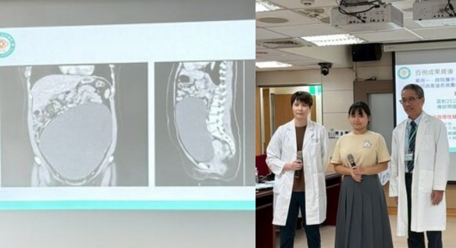 一名19歲的王姓女大生因月經後異常出血就醫，經斷層掃描赫然發現卵巢內長出直徑達30公分的罕見巨大腫瘤，腹部隆起形同懷孕後期。（醫院提供）