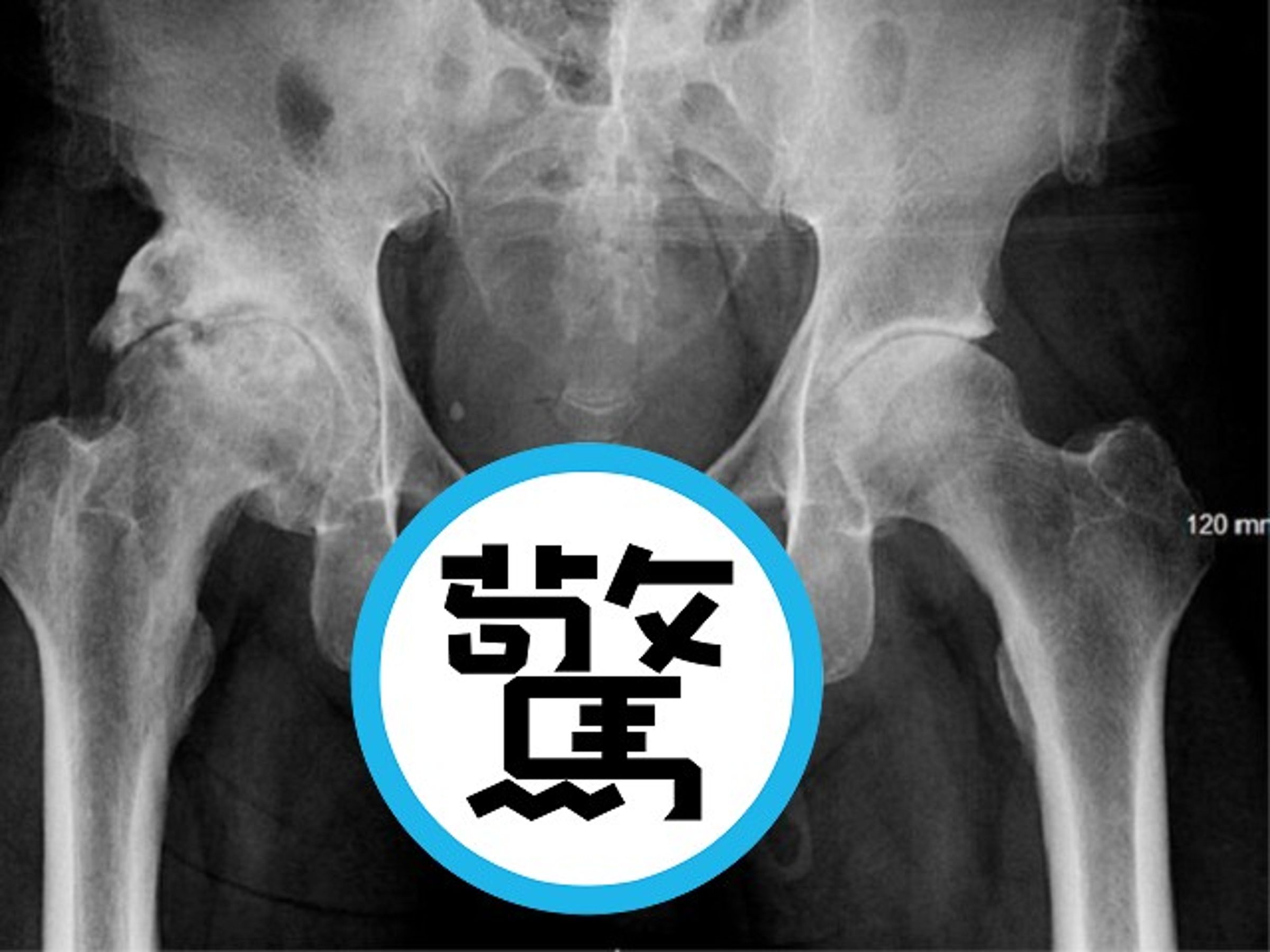 男子下盤膝蓋痛就醫，驚！醫師發現他生殖器「整支鈣化變硬骨頭」。（翻自《太陽報》）