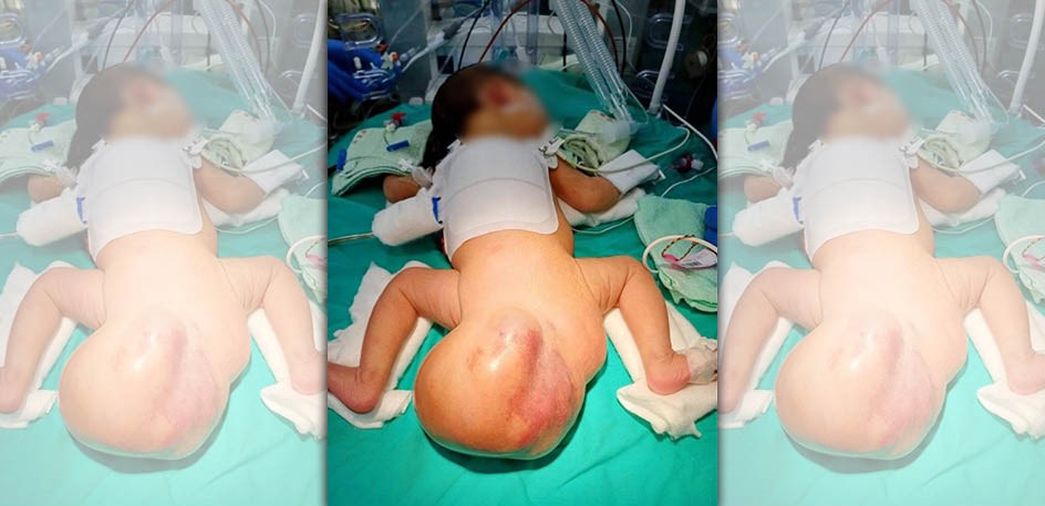 女嬰出生時臀部掛著一顆直徑近16公分、外觀宛如「大球」的巨大腫瘤。（澄清醫院提供）