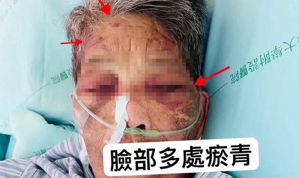 阿嬤臉上青一片、紫一片,到處都是瘀青。(翻攝畫面)
