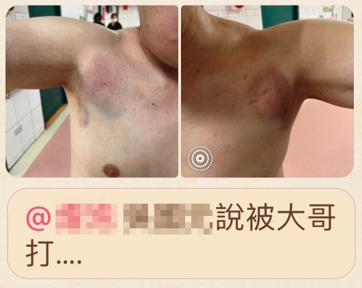 吳姓男子（圖）也遭痛毆，全身滿是傷痕。（投訴人提供）
