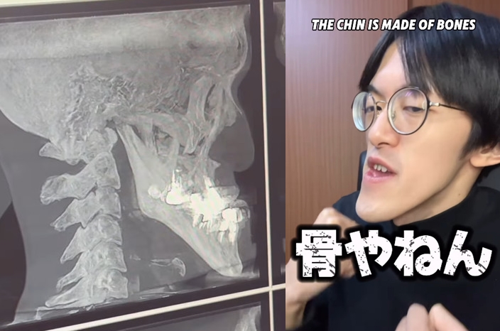 日本網紅城之內因下巴特別突出，特地前往診所拍X光片想一探究竟。（翻攝IG@agonagasugi_）