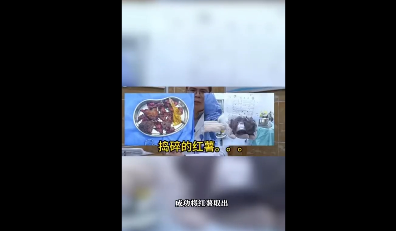 醫師最終以開腹方式取出男子體內的地瓜。(翻攝自微博)