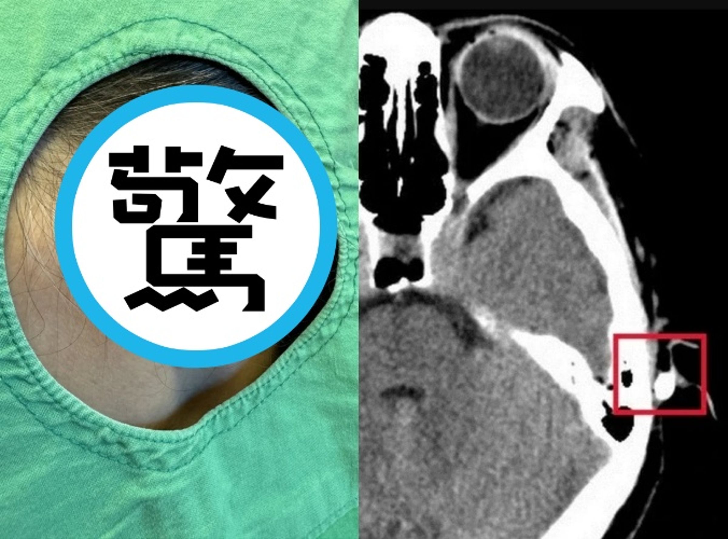 一名婦人在家中客廳不慎踩空，撞到餐桌被筷子插進耳朵裡，嚇壞家人。（台北慈濟醫院提供）