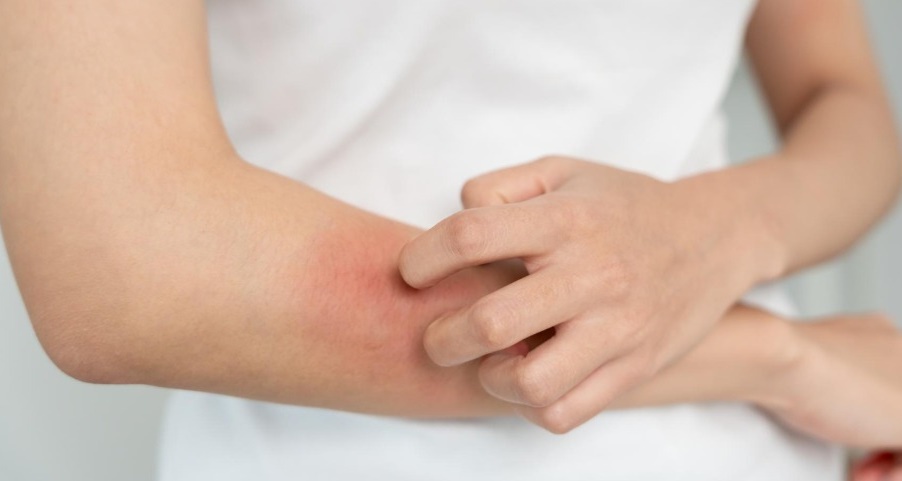 今年出現首例本土M痘病例（mpox，舊稱猴痘），個案為台中市一名30多歲本國籍男性。示意圖。（翻攝自pixabay）