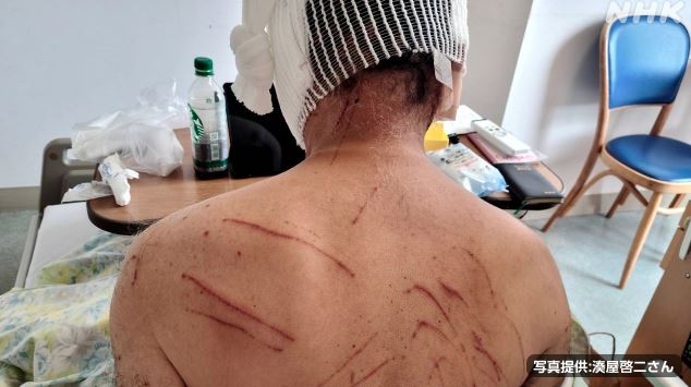 湊屋啓二頭部、臉部與背部遭抓傷，腹部和腋下也被咬傷。（翻攝自NHK）