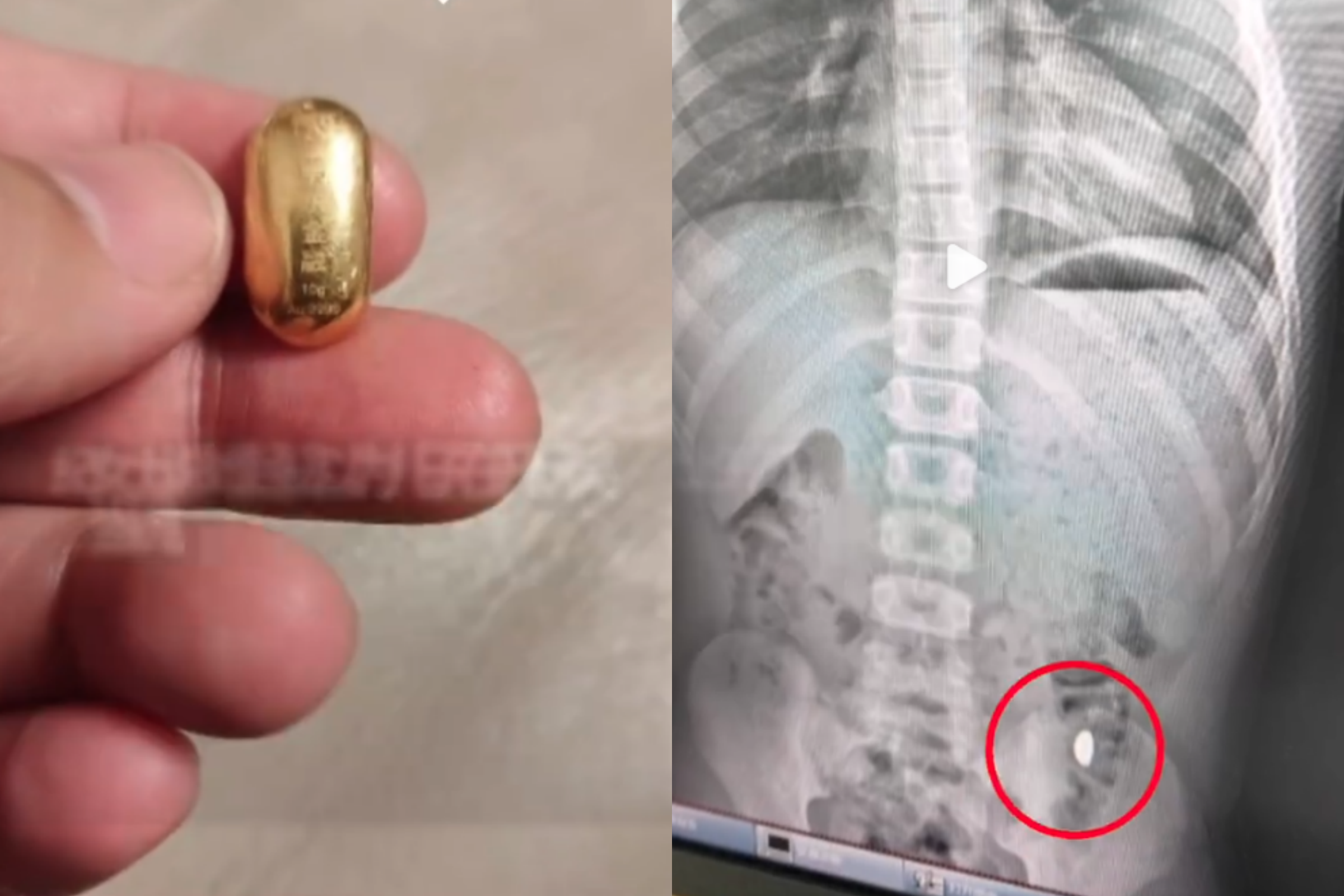 中國一名11歲男童拿價值數萬元的金豆鍛鍊舌頭肌肉，卻意外吞下。（翻攝自微博）