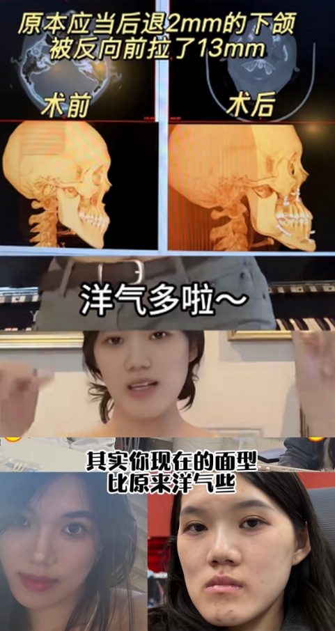小雨接受正顎手術後,臉變歪斜的戽斗臉,主刀醫生還嘲諷這樣比較洋氣。(翻攝微博)