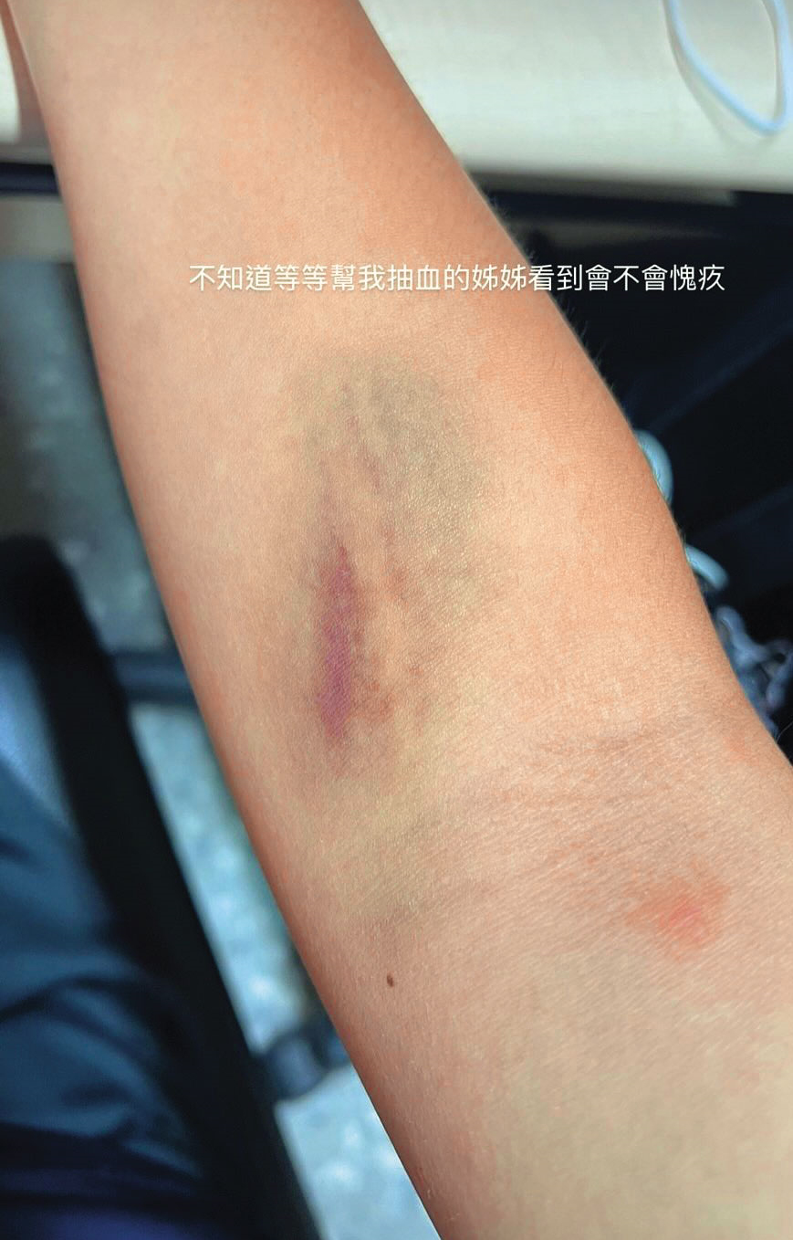 女足隊員簡奇陞手臂抽血處出現大片瘀青，看起來怵目驚心。（翻攝簡奇陞Threads）