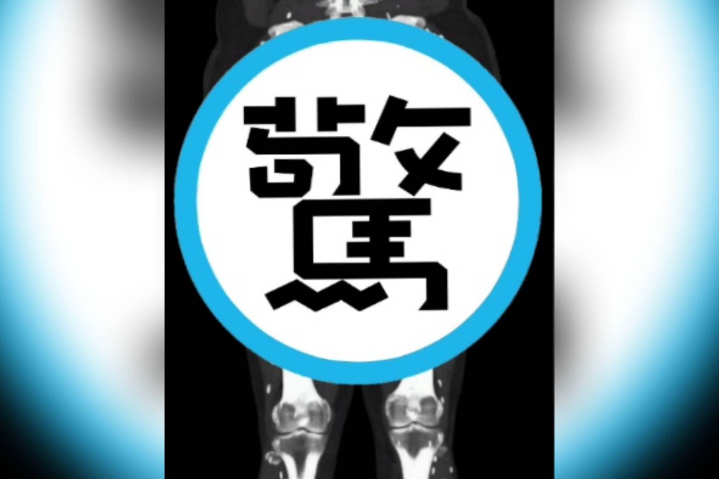 一名醫生曬出感染囊蟲病病患的CT掃描照。(翻攝自X @EM_RESUS)