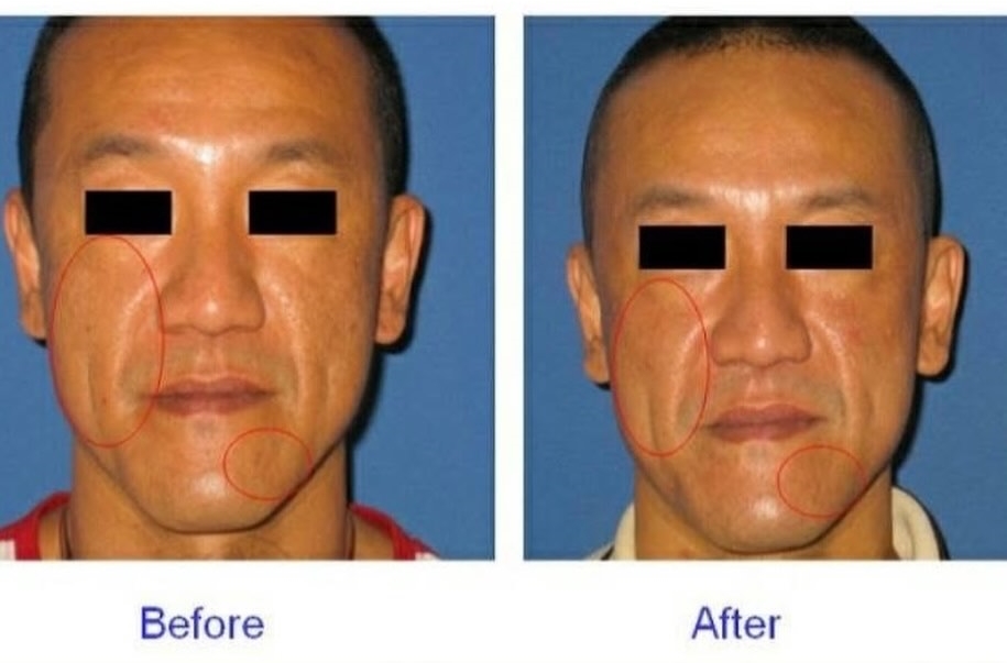 社群媒體近日瘋傳一張醫美前後對比照，許多人一看到就發現當事人是資深藝人陳為民。（翻攝自Threads）