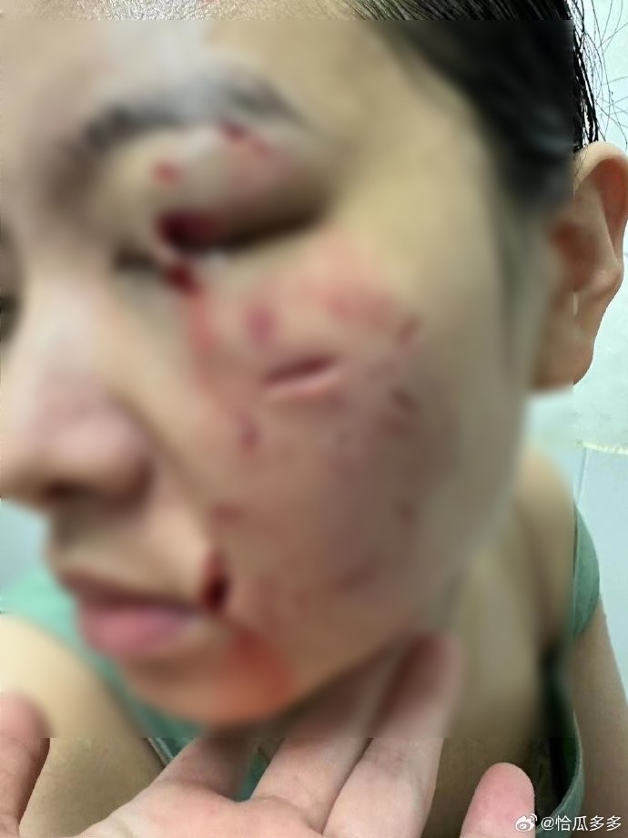 人妻被咬到嚴重破相。(翻自微博)