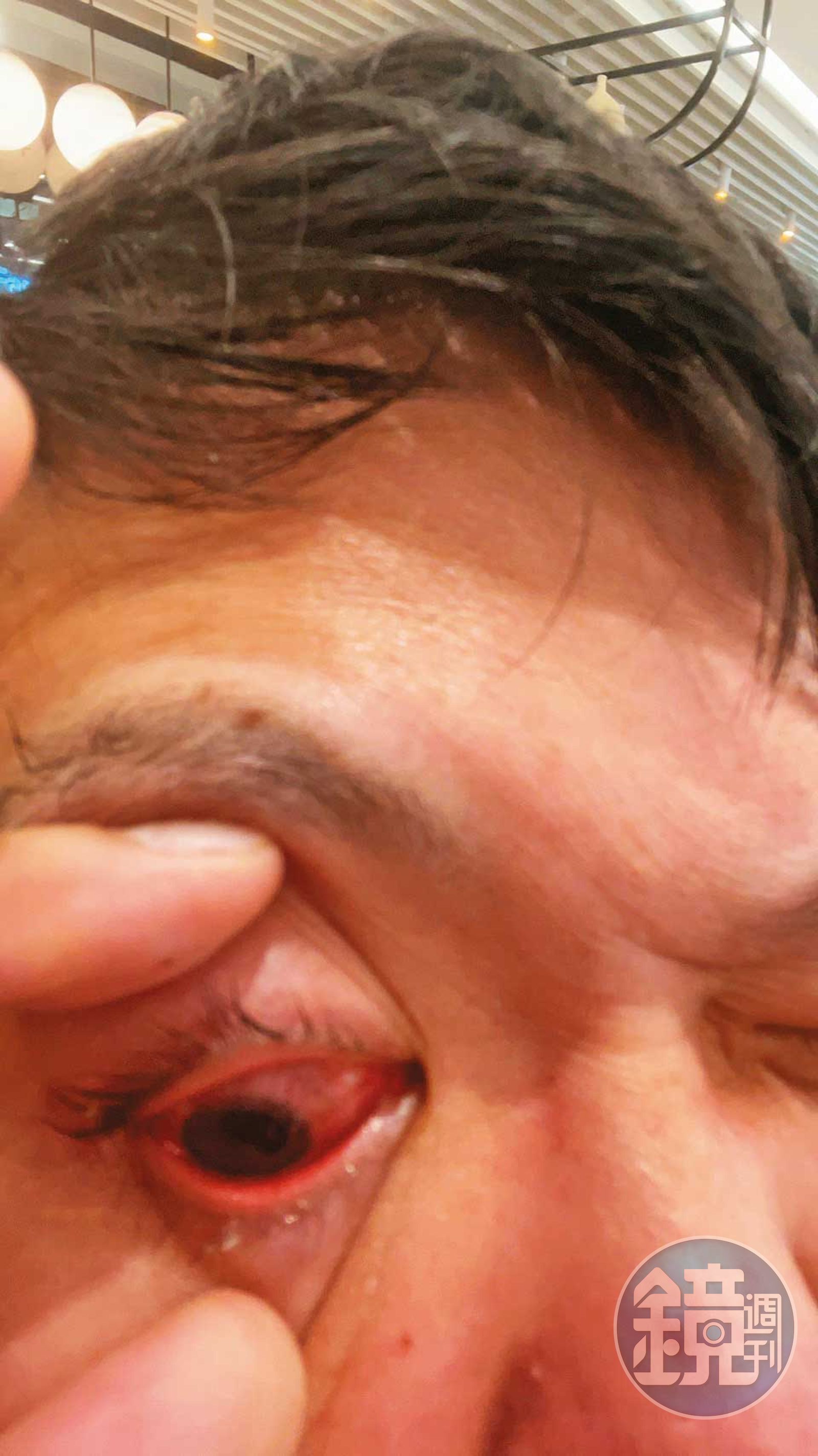 被警方壓制過程中，黃先生的眼角膜破裂受傷。（讀者提供）