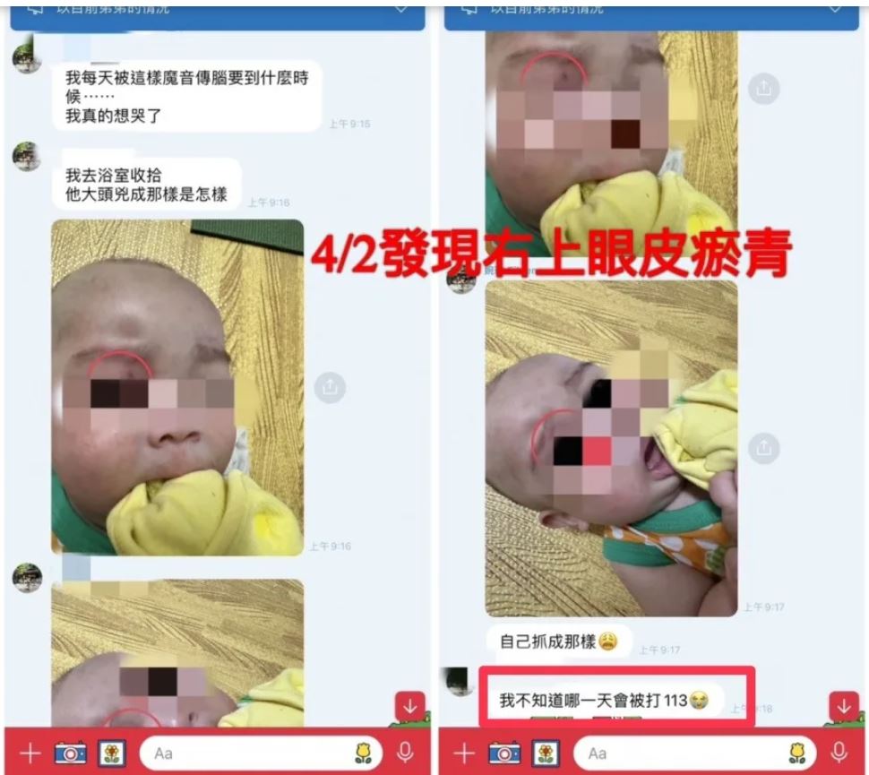 家長指出，男嬰身上接連出現瘀傷，但因保母主動用LINE通報，並說明受傷理由，所以當時不疑有他。（家長提供）