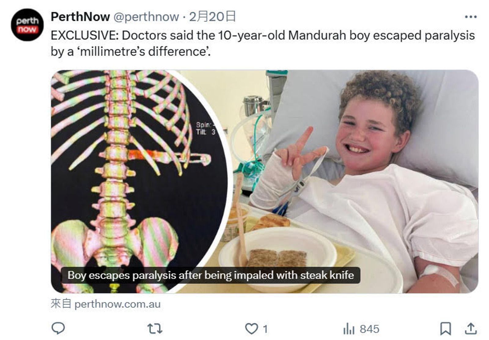 10歲男童因背部插入一把牛排刀,險些癱瘓,幸好急救後已無大礙。(翻攝X@perthnow)