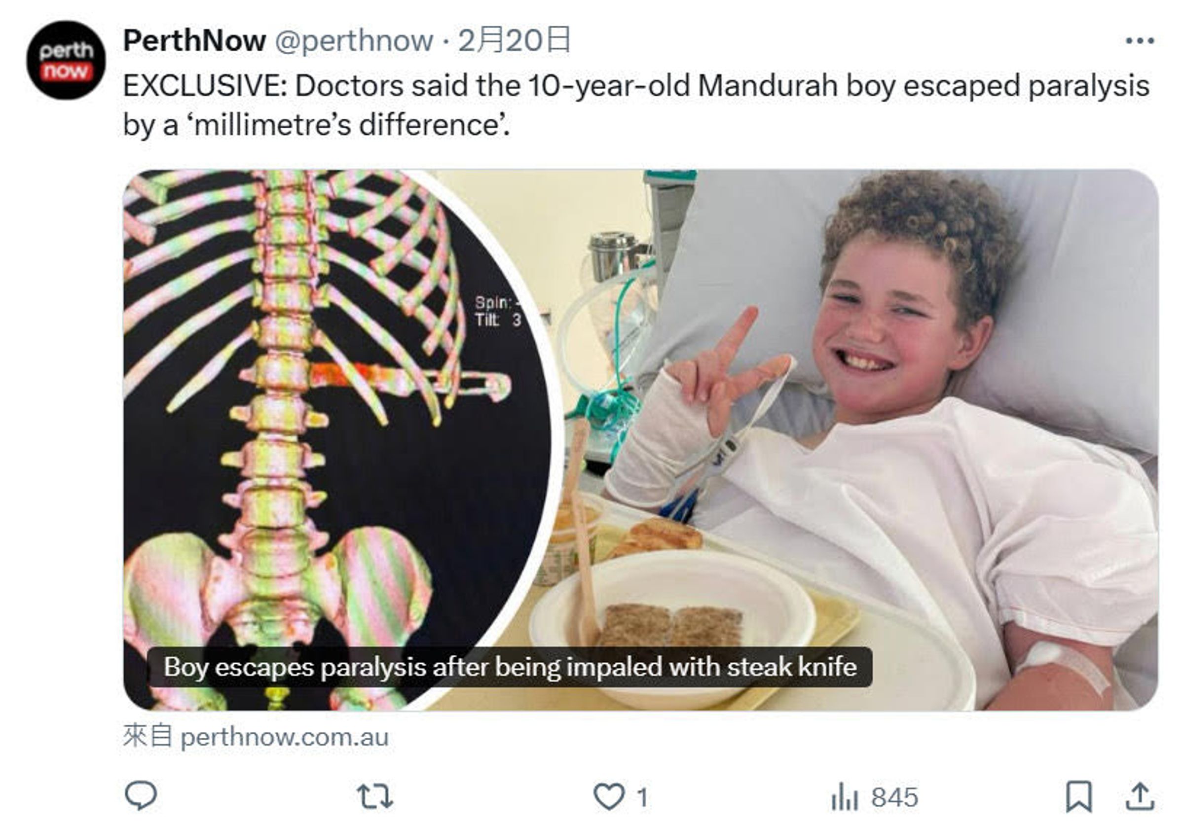 10歲男童因背部插入一把牛排刀,險些癱瘓,幸好急救後已無大礙。(翻攝X@perthnow)