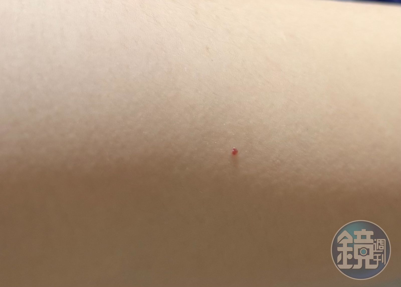 「身上狂長鮮紅小斑點」嚇壞...是肝不好還是罹癌? 醫師曝真相!2大異狀快就醫