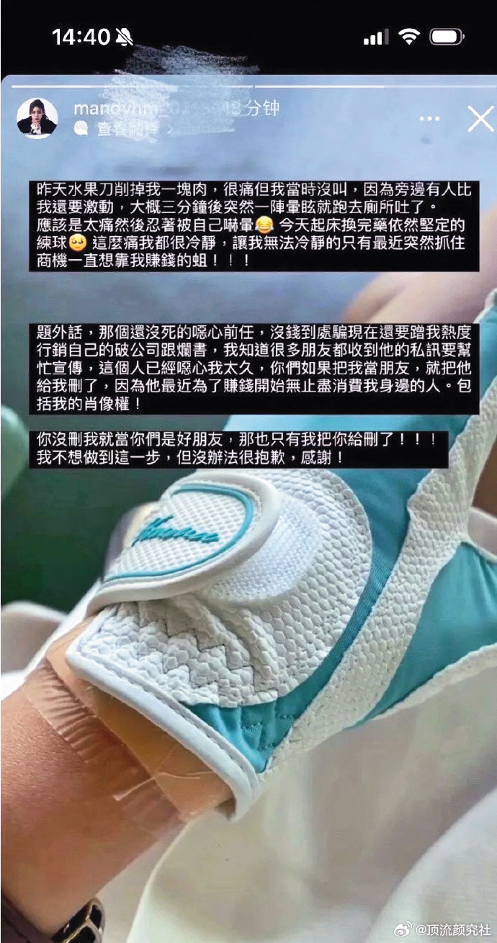 日前汪小菲未婚妻Mandy在網路上發文，除曬出受傷的手部照片，也開罵前任消費她。（圖／翻攝自微博）