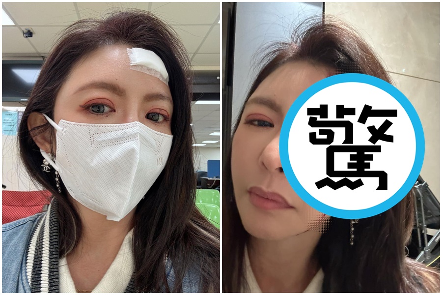 李芳瑜因為老公遭遇血光之災，所幸並無大礙。（翻攝自芳瑜 FiSha Lee臉書）