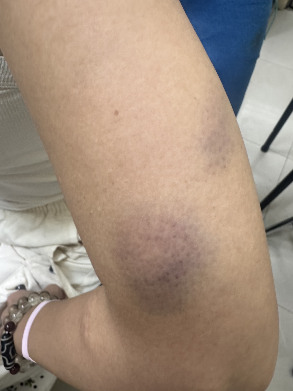 李沛綾左手多處挫傷瘀青，疼痛導致目前無法正常抬起。本人提供