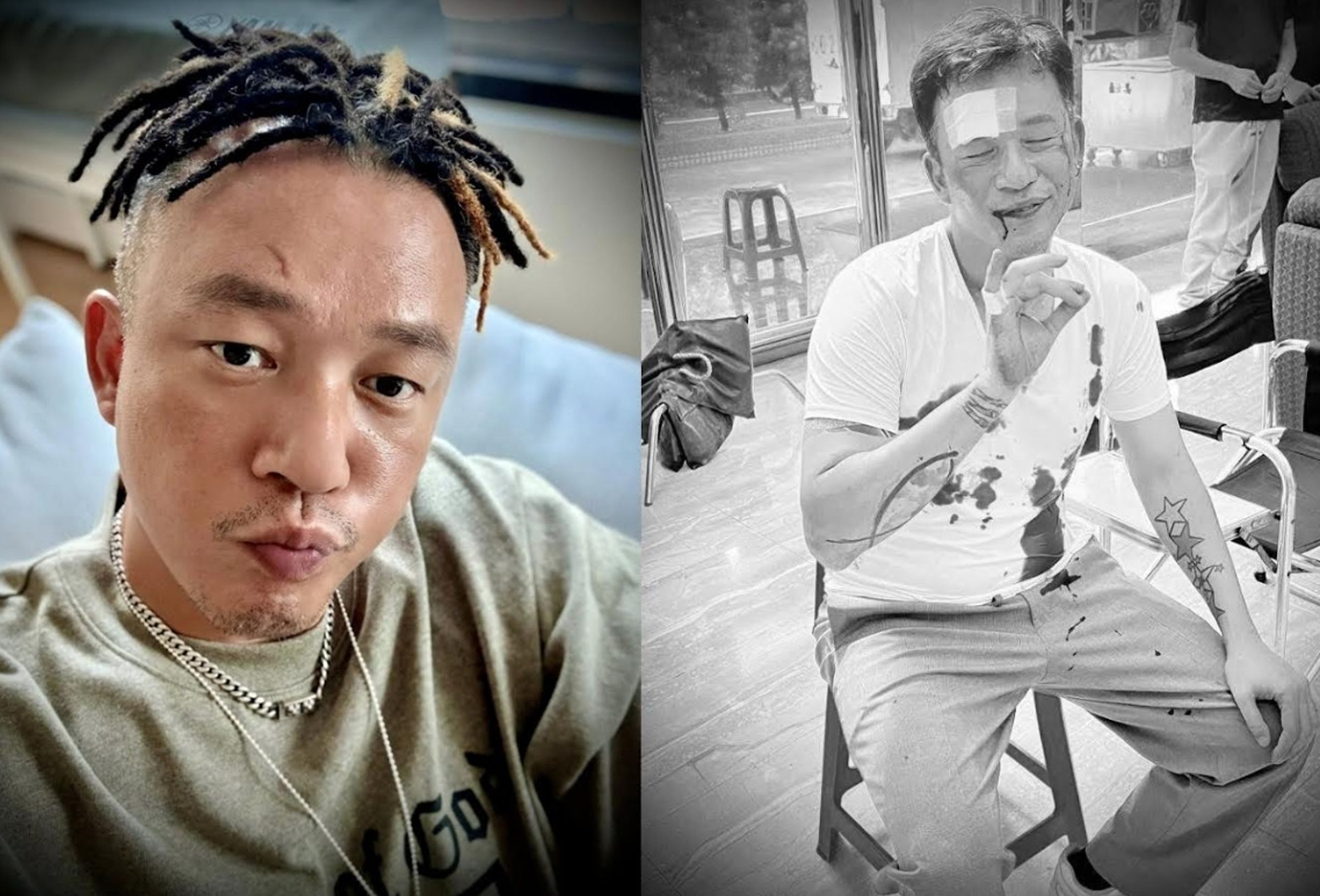 阿Ben拍戲意外受傷,強調未責怪任何人,感謝及時送醫與團隊照顧。(翻攝臉書)
