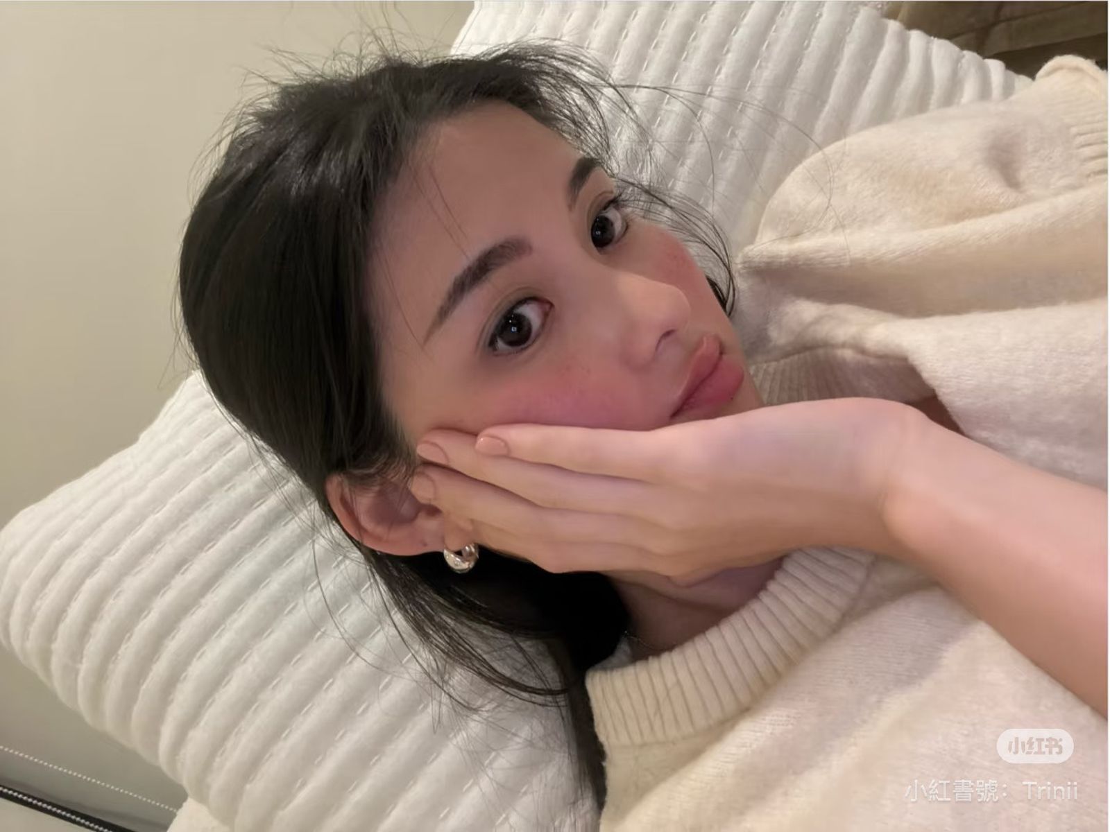 廖思惟曬出近距離素顏照，臉頰紅斑明顯。（翻攝Trinity廖思惟小紅書）