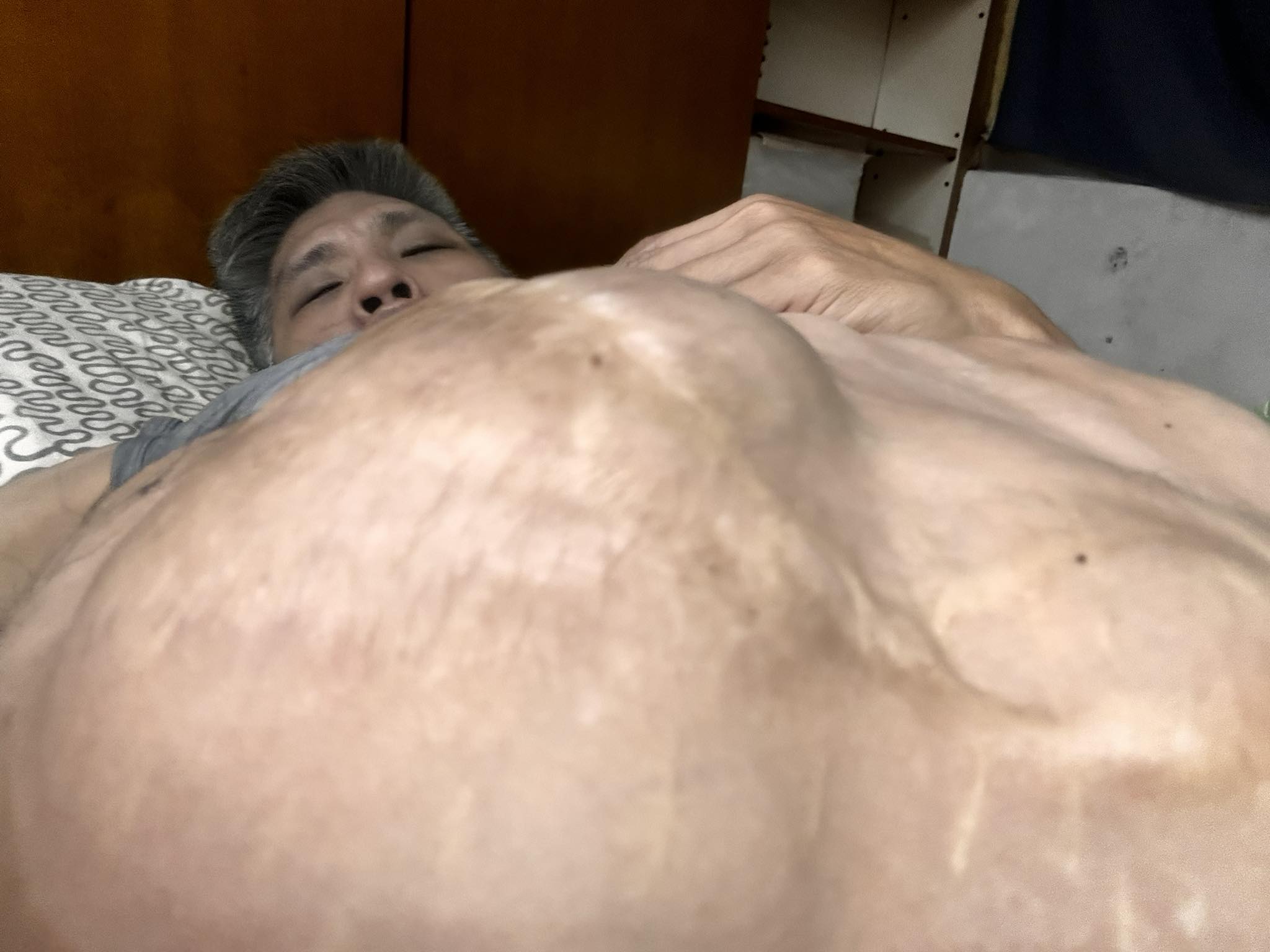 張忠義曬出「腹部高度腫脹」照片，並提到面對嚴峻的身體不適，「忠義始終以堅定態度面對治療，從不言棄。」（翻攝自張忠義臉書）