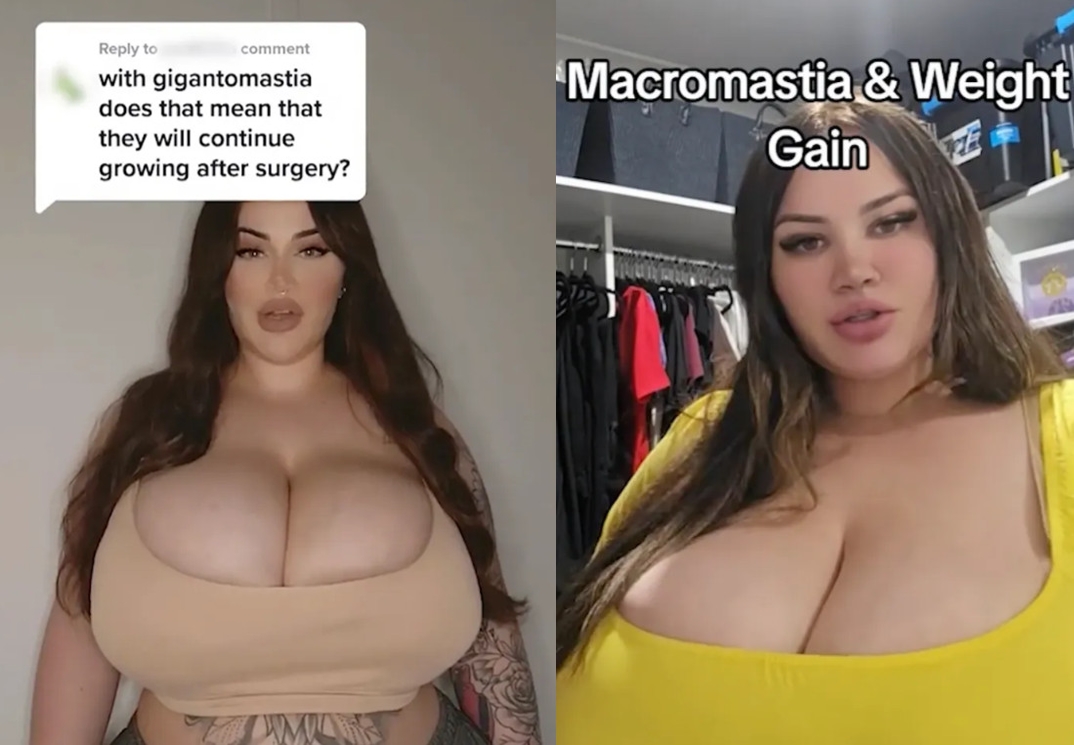 漢密爾頓因罹患巨乳症導致胸部持續增大，已對她的呼吸功能造成嚴重影響。（翻攝TikTok）