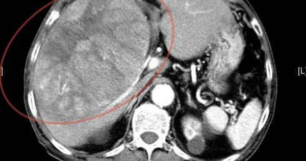 阿公熱心當志工，平日也愛健行登山，身體一直很硬朗，卻在高血壓背後發現了驚人病灶。（翻攝自臉書 ＠錢政弘 胃腸肝膽科醫師）