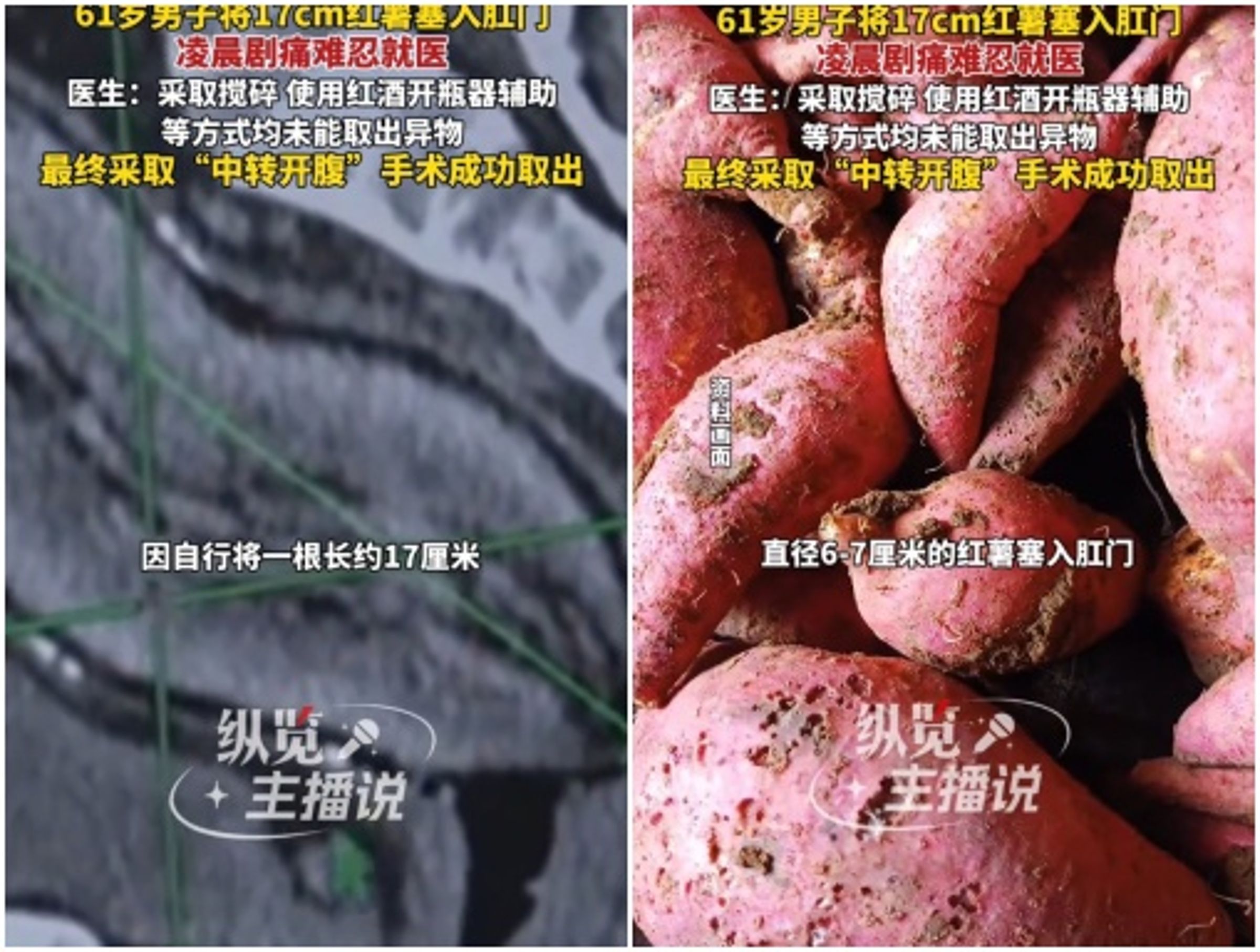 中國7旬翁肛門塞17cm地瓜無法自行取出,緊急就醫。(翻攝抖音)