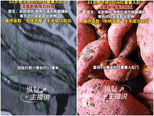 中國7旬翁肛門塞17cm地瓜無法自行取出,緊急就醫。(翻攝抖音)
