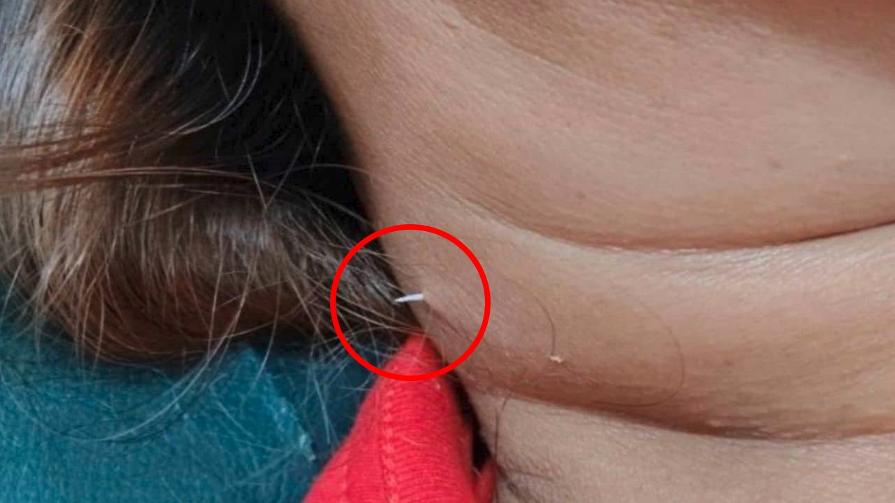 女子脖子腫痛多日，竟發現魚刺從皮膚穿出，畫面怵目驚心。（翻攝自thethaiger）