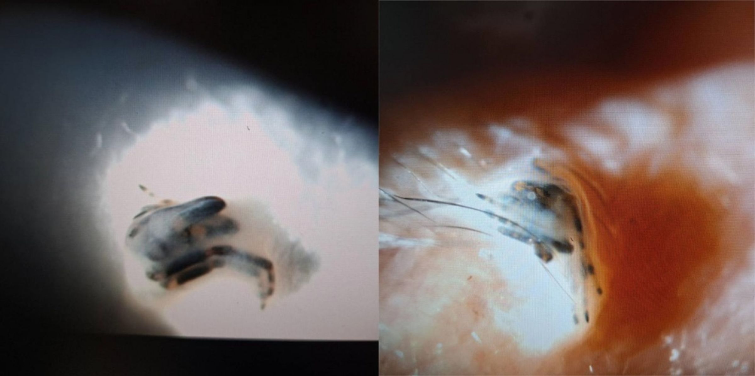 屏東縣一名中年男子因午睡時遭蜘蛛爬入右眼，導致結膜與毛囊嚴重發炎，所幸經眼科醫師緊急處理已無大礙。（洪啟庭醫師提供）