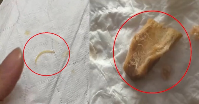 中國民眾在螺螄粉裡面吃到指甲（左）、菸蒂（右）。（翻攝自微博）