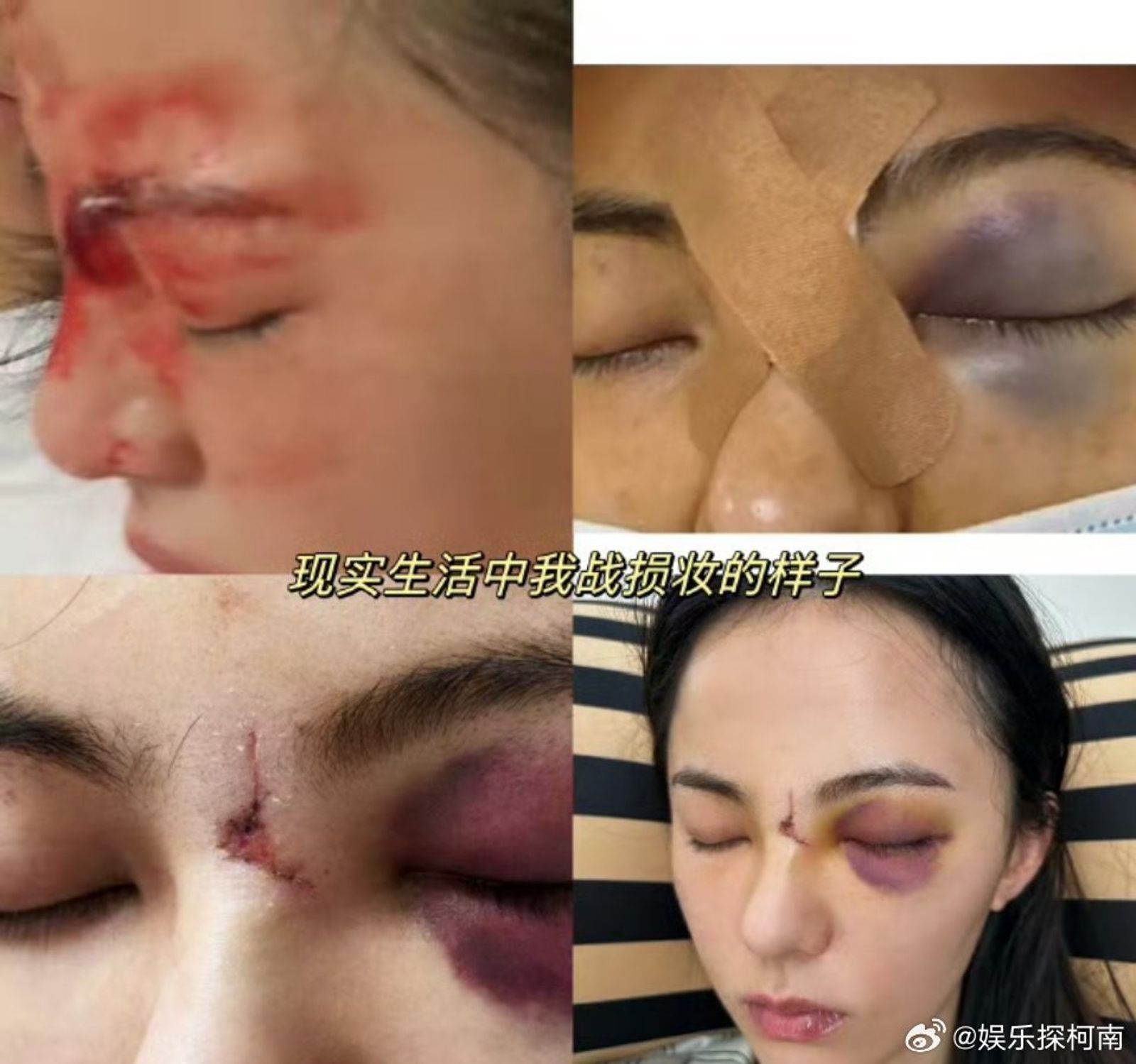 原本演出女二角色的女星黃日瑩武打訓練時臉受傷,竟被踢出劇組,由李凱馨取代。(微博圖片)