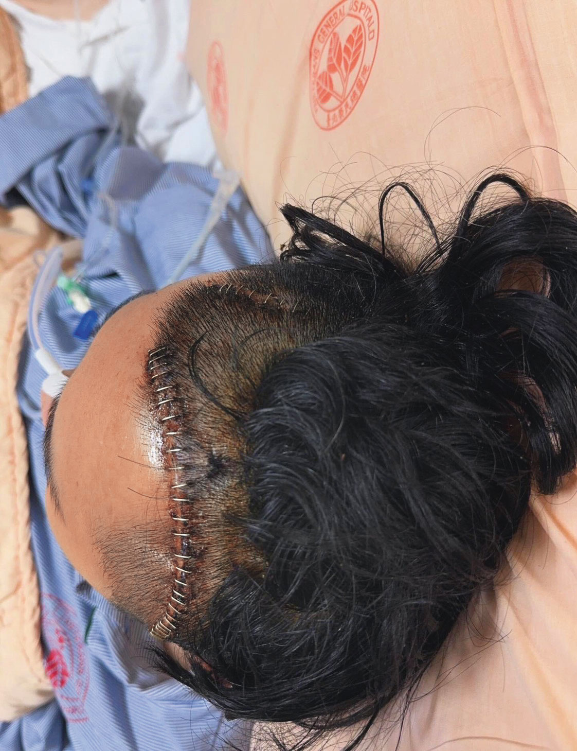 杜男抵達醫院時中度腦出血、腦部受損，隨即進行開顱手術，撿回一命。（讀者提供）