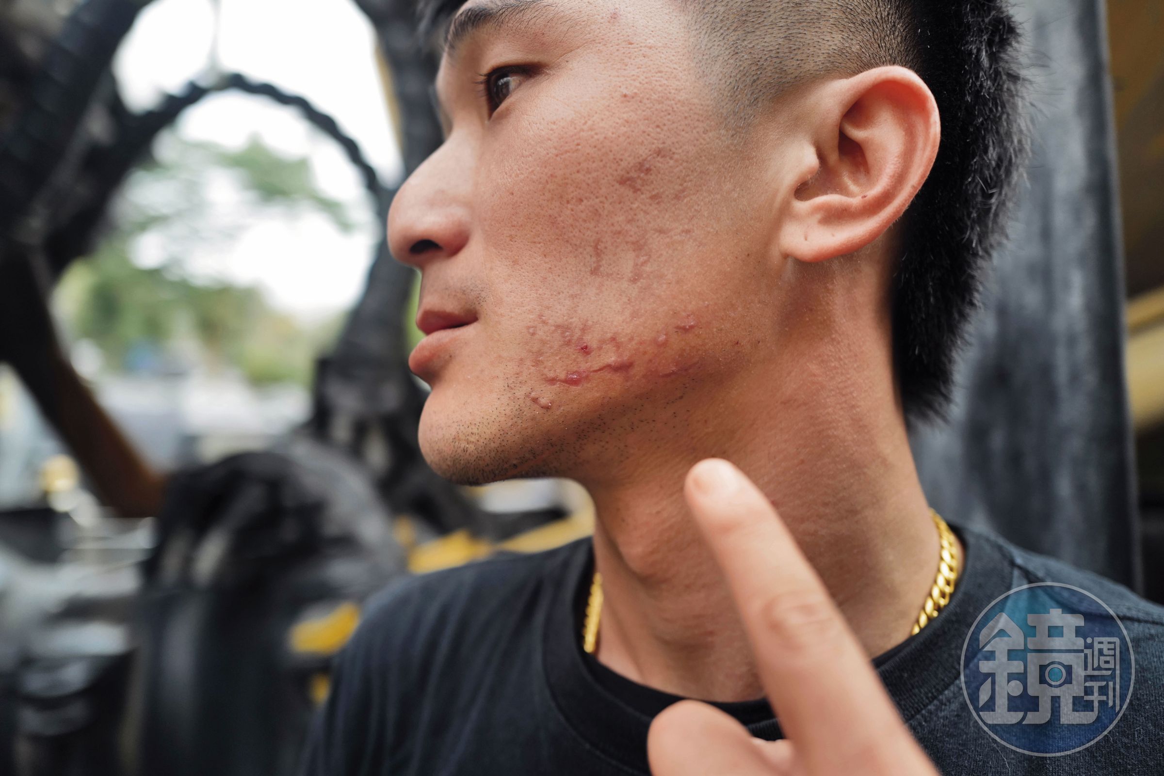 陳少閎擔任補給前鋒車時，遭彈起的落石穿破擋風玻璃，玻璃飛噴刺入他半邊的臉，2個禮拜後仍有未癒的傷口。