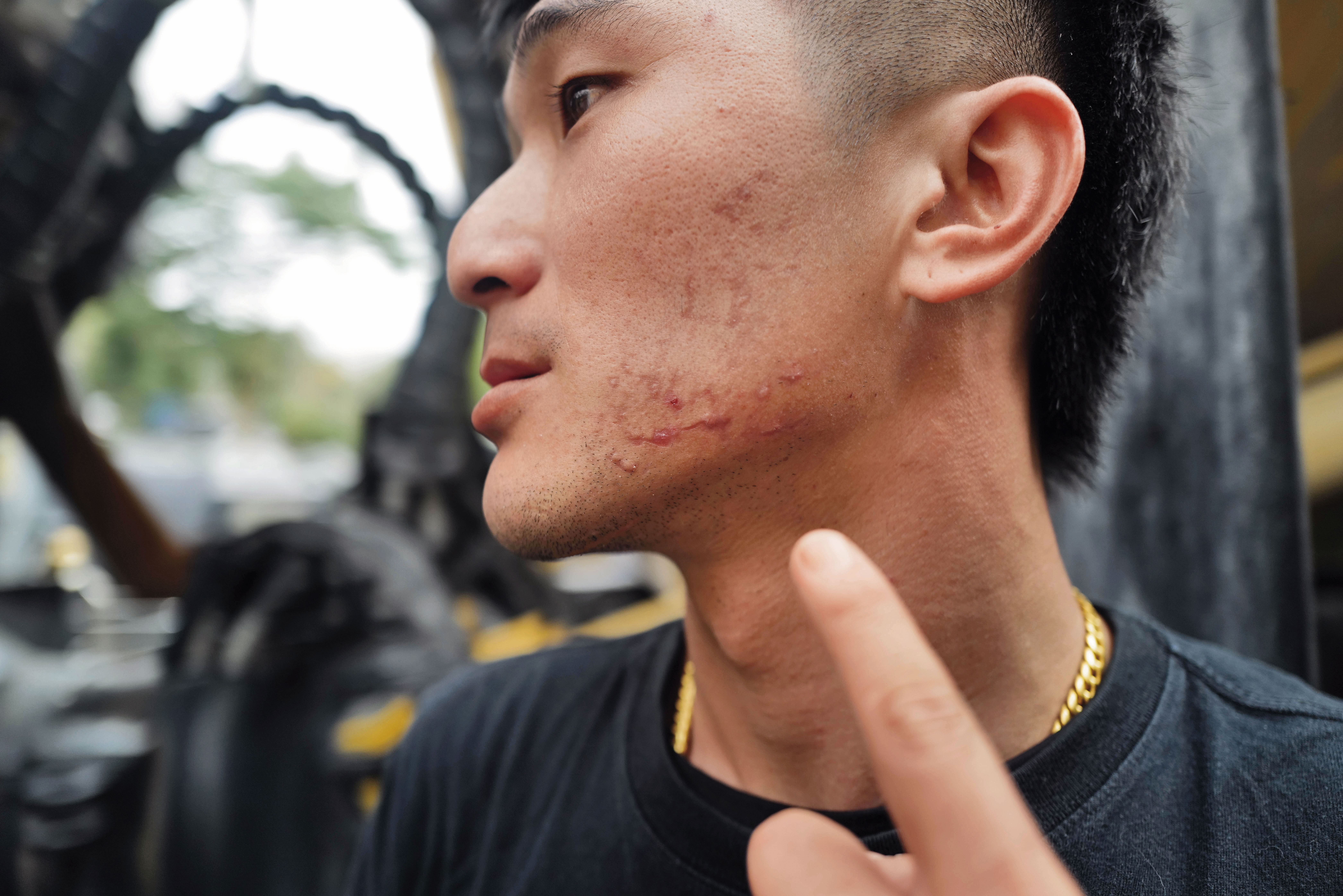 陳少閎擔任補給前鋒車時,遭彈起的落石穿破擋風玻璃,玻璃飛噴刺入他半邊的臉,2個禮拜後仍有未癒的傷口。