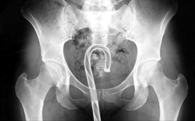 聖誕節要色色！「耶誕老人的魔杖棒棒糖」拔不出來。（翻自《每日郵報》）