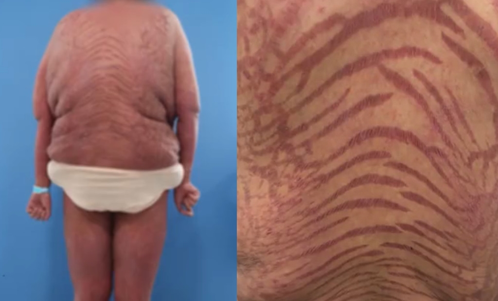 南京一名女病患濫用網上來歷不明的藥膏，導致身上爬滿紫色裂紋，而且身材嚴重發福。（翻攝微博）