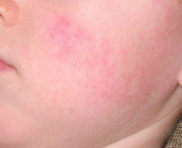 台中一名11歲女童感冒後猝逝，女童多項檢體驗出B19微小病毒。（示意圖，取自疾管署網站）