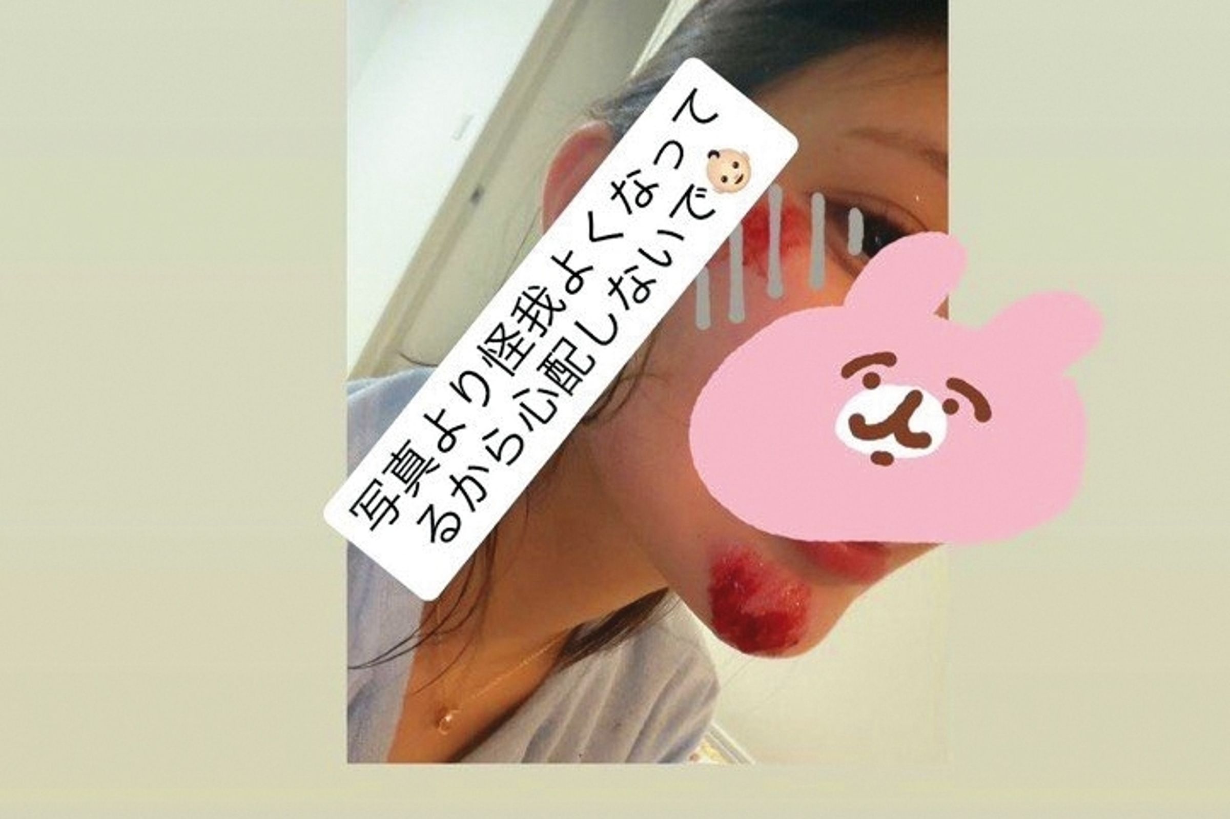 流出的對話截圖中,倉木華曾貼出自己的臉部傷勢,控訴事故後平良翔太避不處理。(翻攝自倉木華IG)