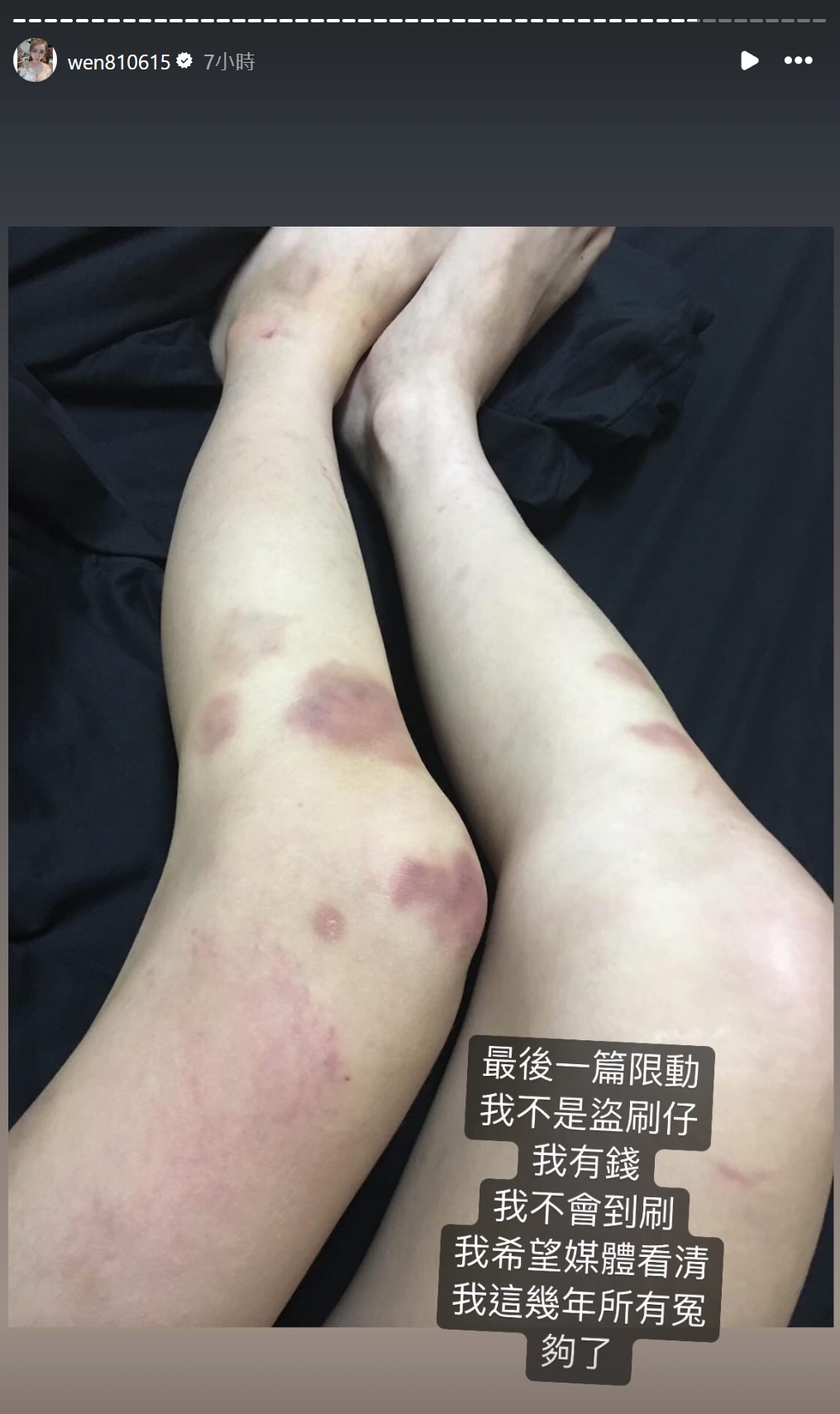 罔腰指控過去遭鳳梨狂毆，還附上雙腳有多處瘀青的照片。（翻攝自罔腰IG）